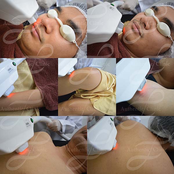 Miracle IPL Hair Removal