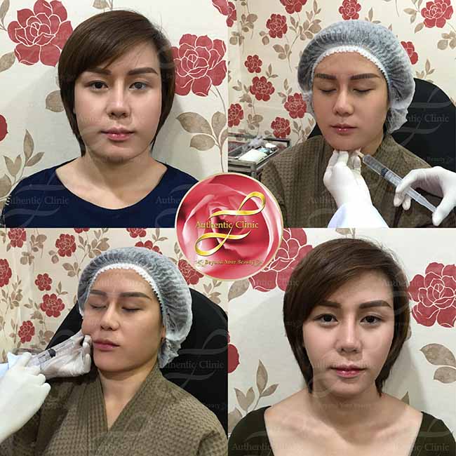 LLD Fat Facial Firming