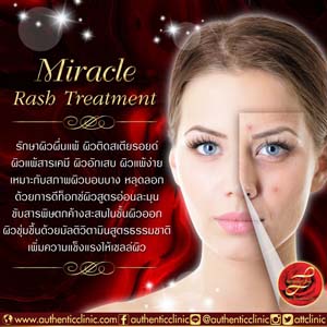 Miracle-Rash-Treatment